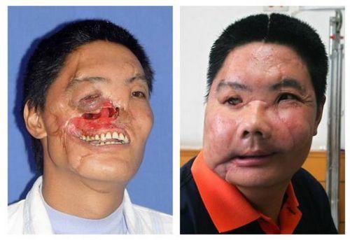 这组照片显示了一名男子在手术前和手术后的比较。这名西安男子姓李，在2004年遭受了熊袭，在一个国际支援组织和西安医院13小时手术的帮助后，成为了如右图所示的样子。