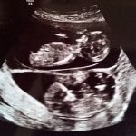 异期复孕：女子在怀孕期间又怀上一个